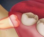 Mọc răng khôn: Triệu chứng và những lưu ý quan trọng