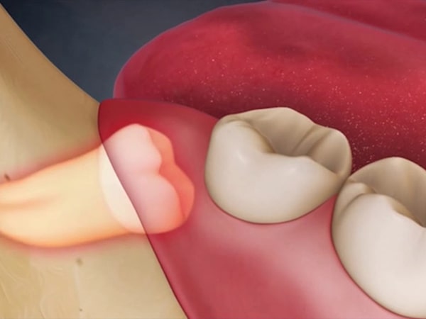 Mọc răng khôn: Triệu chứng và những lưu ý quan trọng 