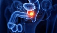 dấu hiệu ung thư tuyến tiền liệt