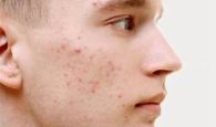cách trị mụn trứng cá ở tuổi dậy thì