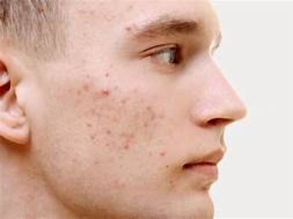 cách trị mụn trứng cá ở tuổi dậy thì