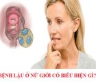triệu chứng của bệnh lậu