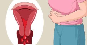triệu chứng của ung thư cổ tử cung