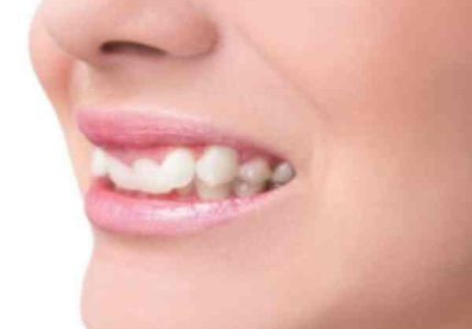 tướng răng chó ở người