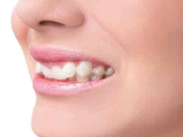 tướng răng chó ở người